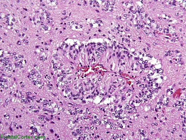 Angiocentric glioma, H&E stain x400